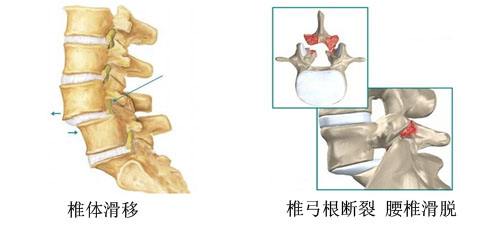 腰椎滑脱