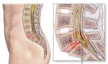 为什么椎管会变得狭窄
