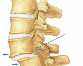 腰椎滑脱症状有哪些？